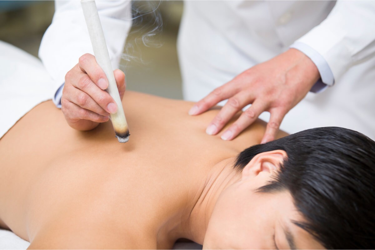Moxibustion at DelCollo Acupuncture, burning mugwort held above acupoints on a patient's back.